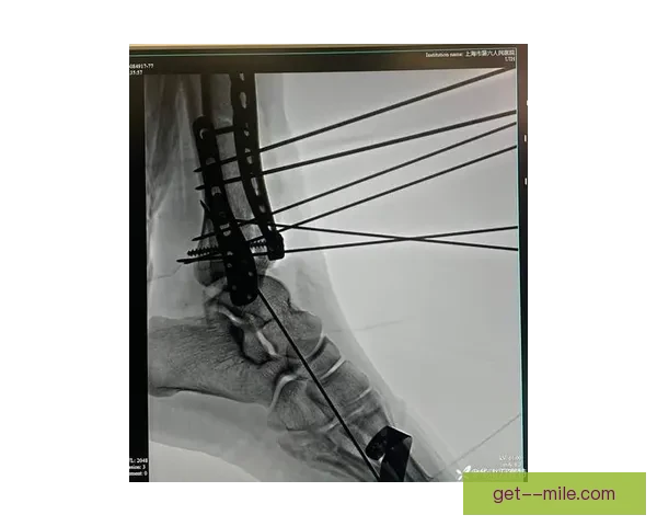 科尔十字韧带断裂后艰难康复过程中的挑战与坚持